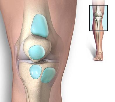 tratamiento de la bursitis de rodilla
