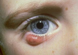 Cebada en el ojo Síntomas y tratamiento